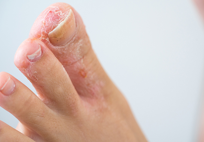 Fußpilz an den Zehen